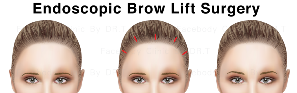 การยกคิ้วด้วยเทคนิค ผ่าตัดผ่านกล้อง Endoscopic Brow Lift​