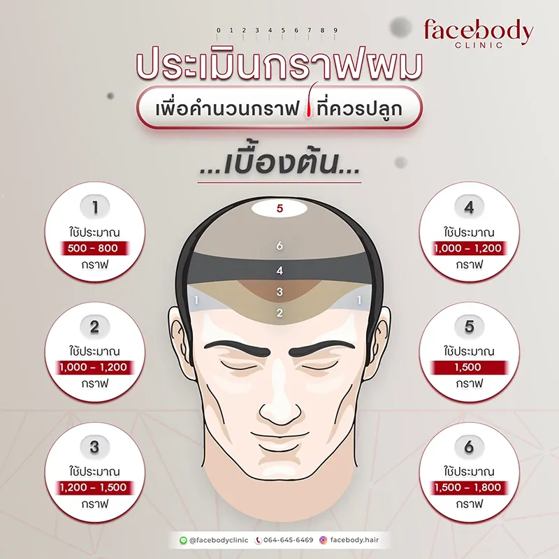 ปลูกผมราคา อัพเดต 2569 เตรียมงบก่อนปลูกผมถาวรให้พร้อม ปลูกผมราคา อัพเดต 2569 เตรียมงบก่อนปลูกผมถาวรให้พร้อม