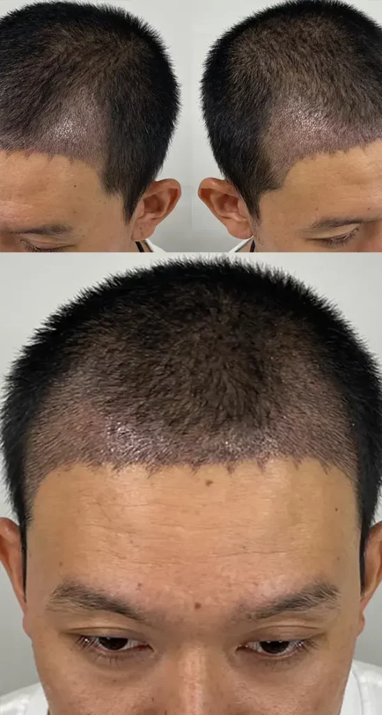 รีวิวปลูกผมถาวร หลังจากอดทนกับ M เว้า 7 ปี​