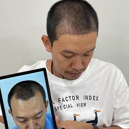 รีวิวปลูกผมถาวร หลังจากอดทนกับ M เว้า 7 ปี​