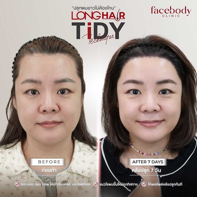 รีวิวปลูกผม Longhair ไม่ต้องโกน ผมยาวทันที เห็นผลจริงหลังทำ รีวิวปลูกผม Longhair ไม่ต้องโกน ผมยาวทันที เห็นผลจริงหลังทำ