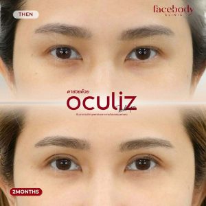 ทำตาสองชั้น โดยทีมอาจารย์แพทย์ เทคนิค Oculiz ปรับดวงตาให้โต สดใส มีมิติ​