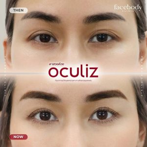 ทำตาสองชั้น โดยทีมอาจารย์แพทย์ เทคนิค Oculiz ปรับดวงตาให้โต สดใส มีมิติ​