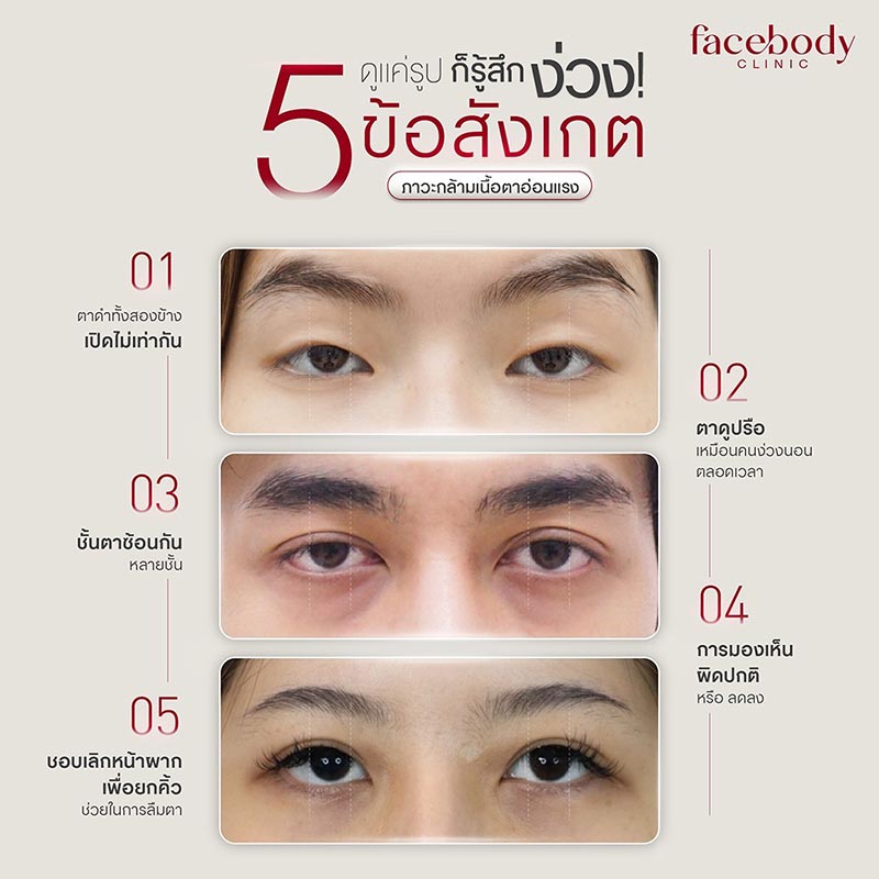 กล้ามเนื้อตาอ่อนแรงคืออะไร? (Myasthenia Gravis): สาเหตุ อาการ การแก้ไขเพื่อดวงตาที่สดใส