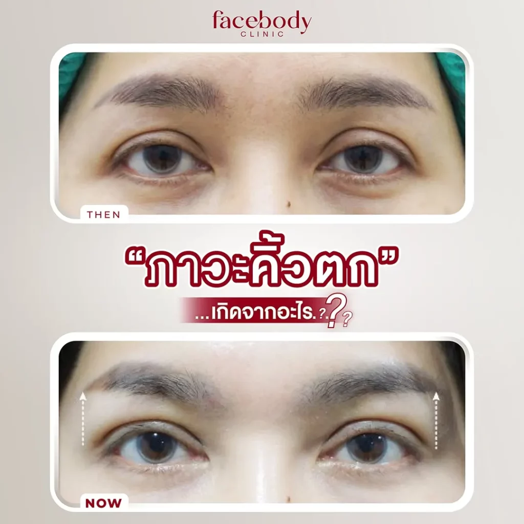 ยกคิ้ว แก้ไขปัญหา คิวตก ลดหน้าเครียด