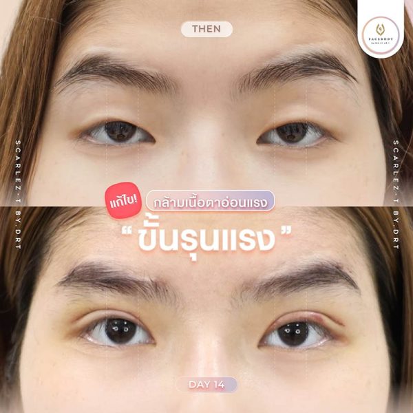 ทำตาสองชั้นราคา