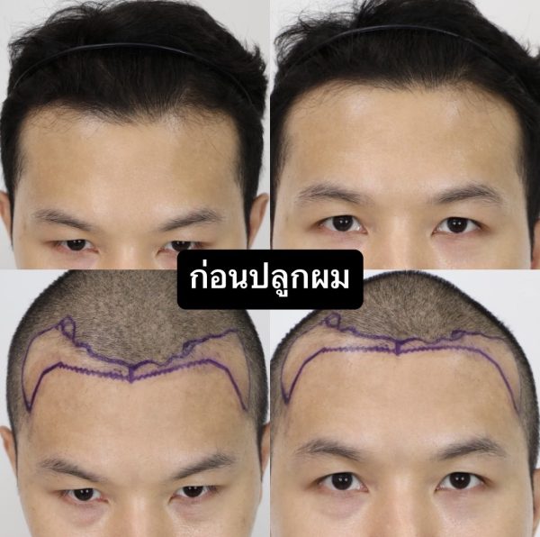 ปลูกผม (ก่อน)