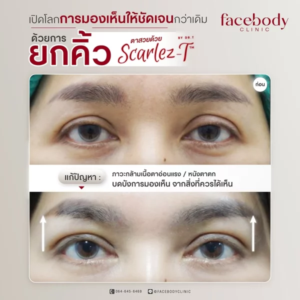 ยกคิ้ว-BA-DR.T-1 ยกคิ้ว-BA-DR.T-1